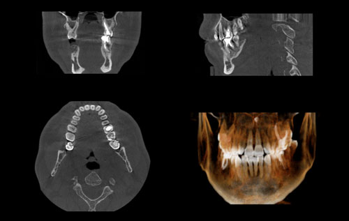 歯科用CTで精密な診断