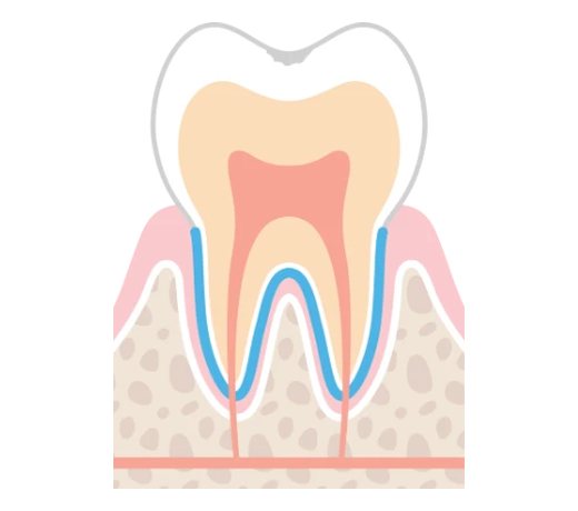C0の虫歯のイラスト。歯の表面がわずかに溶けはじめているが、穴は開いていない