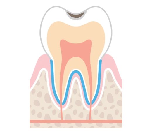 C1の虫歯のイラスト。虫歯が歯の表面のエナメル質にとどまっている
