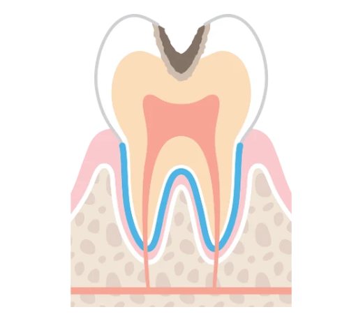 C2の虫歯のイラスト。虫歯がエナメル質の内側の象牙質まで進んでいる