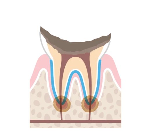 C4の虫歯のイラスト。歯の頭の部分が崩れて根だけが残り、根の先に炎症が起きている