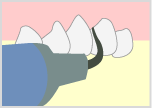 歯石・歯垢除去